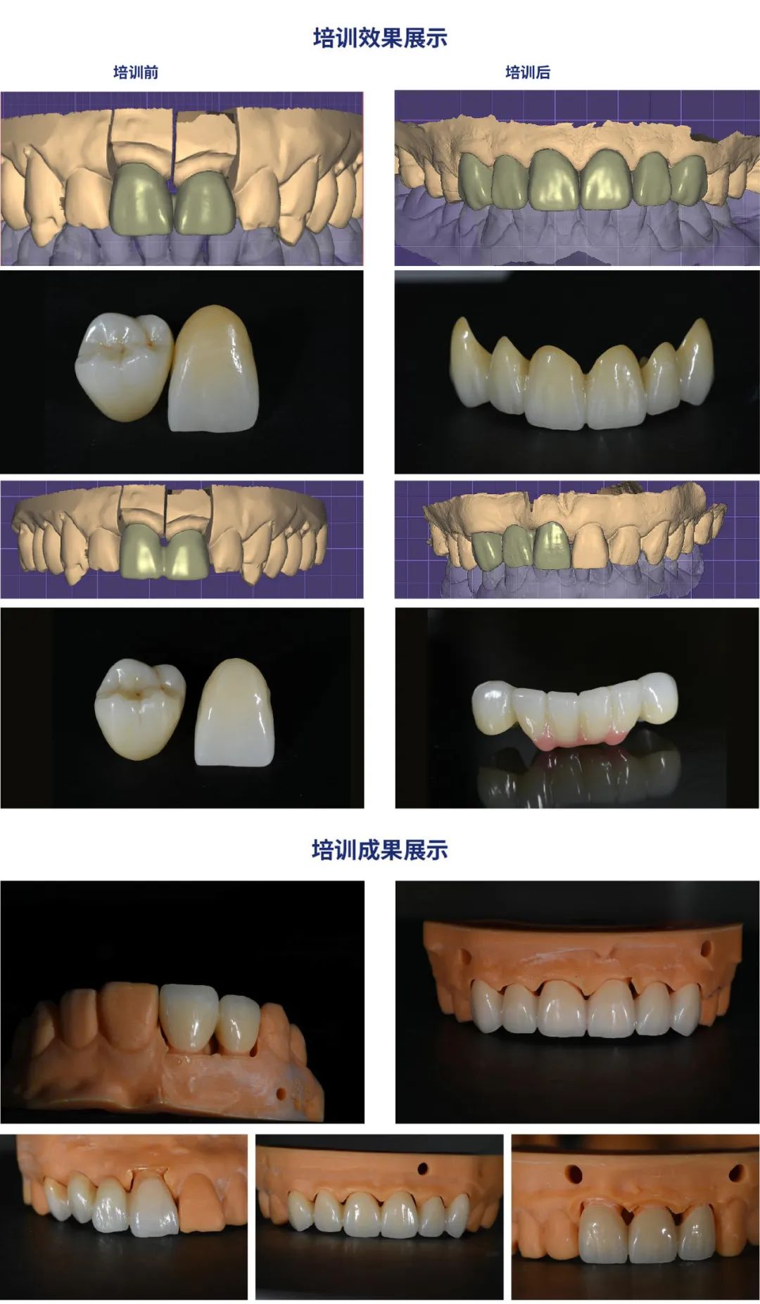 爱迪特义齿加工厂数字化转型方案助力加工厂变革升级!